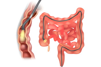 Kolonoskopia - badanie przesiewowe
